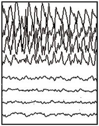 Μερική κατάσχεση EEG