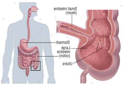 Νόσος του Crohn
