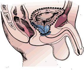 Χειρουργικά όρια ριζική κυστεκτομή σε έναν άνδρα. Το δείγμα περιλαμβάνει την ουροδόχο κύστη, τον προστάτη, και τα σπερματικά κυστίδια.