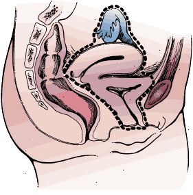 Χειρουργικά όρια ριζική κυστεκτομή σε μια γυναίκα. Το δείγμα περιλαμβάνει την ουροδόχο κύστη και την ουρήθρα ολόκληρο, μήτρα, ωοθήκες, σάλπιγγες, και το πρόσθιο τοίχωμα του κόλπου.