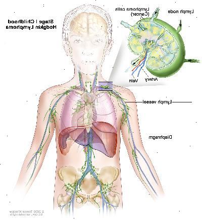 Στάδιο Ι παιδική Hodgkin λέμφωμα? Σχέδιο δείχνει καρκίνο σε μία ομάδα λεμφαδένας πάνω από το διάφραγμα. Ένα ένθετο δείχνει ένα λεμφαδένα με ένα δοχείο λεμφαδένες, μία αρτηρία, και μια φλέβα. Τα κύτταρα λεμφώματος του καρκίνου που περιέχουν δείχνεται στο λεμφαδένα.