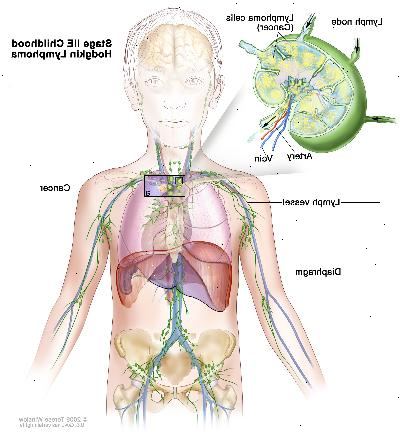 Στάδιο IIE παιδική ηλικία Hodgkin λέμφωμα? Σχέδιο δείχνει καρκίνο σε μία ομάδα λεμφαδένας πάνω από το διάφραγμα και στον αριστερό πνεύμονα. Ένα ένθετο δείχνει ένα λεμφαδένα με ένα δοχείο λεμφαδένες, μία αρτηρία, και μια φλέβα. Τα κύτταρα λεμφώματος του καρκίνου που περιέχουν δείχνεται στο λεμφαδένα.