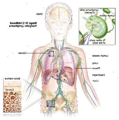 Στάδιο IV παιδική Hodgkin λέμφωμα? Σχέδιο δείχνει τον καρκίνο στο ήπαρ, στον αριστερό πνεύμονα, και σε μία ομάδα λεμφαδένας κάτω από το διάφραγμα. Ο εγκέφαλος και το υπεζωκότα δείχνονται επίσης. Ένα ένθετο δείχνει τον καρκίνο εξαπλώνεται μέσω λεμφαδένων και λεμφικών αγγείων σε άλλα μέρη του σώματος. Τα κύτταρα λεμφώματος περιέχει καρκίνου που εμφανίζονται μέσα σε ένα λεμφαδένα. Ένα άλλο ένθετο δείχνει τα καρκινικά κύτταρα στο μυελό των οστών.