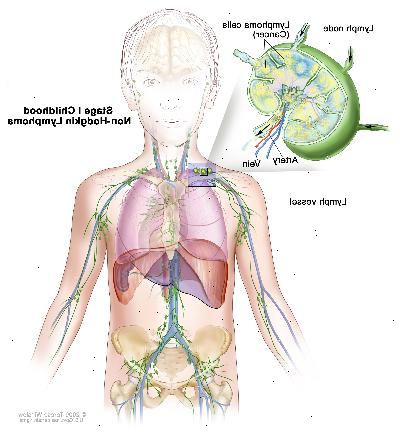 Στάδιο Ι της παιδικής ηλικίας μη-Hodgkin λέμφωμα? Σχέδιο δείχνει καρκίνο σε μία ομάδα των λεμφαδένων. Ένα ένθετο δείχνει ένα λεμφαδένα με ένα δοχείο λεμφαδένες, μία αρτηρία, και μια φλέβα. Τα κύτταρα λεμφώματος του καρκίνου που περιέχουν δείχνεται στο λεμφαδένα.