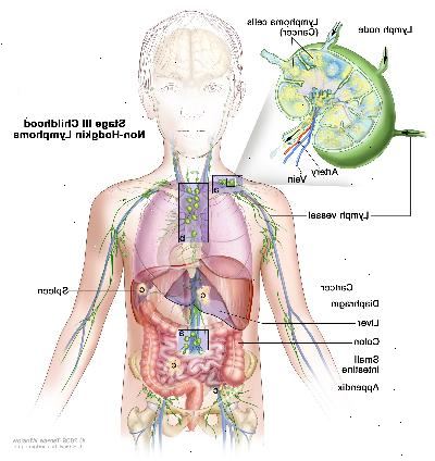 Σταδίου III παιδική ηλικία μη-Hodgkin λέμφωμα? Σχέδιο δείχνει καρκίνο σε λεμφαδένες ομάδες κόμβο πάνω και κάτω από το διάφραγμα, στο στήθος, και καθ 'όλη την κοιλιά στο ήπαρ, σπλήνα, μικρό έντερο, και το προσάρτημα. Η άνω και κάτω τελεία δείχνεται επίσης. Ένα ένθετο δείχνει ένα λεμφαδένα με ένα δοχείο λεμφαδένες, μία αρτηρία, και μια φλέβα. Τα κύτταρα λεμφώματος του καρκίνου που περιέχουν δείχνεται στο λεμφαδένα.