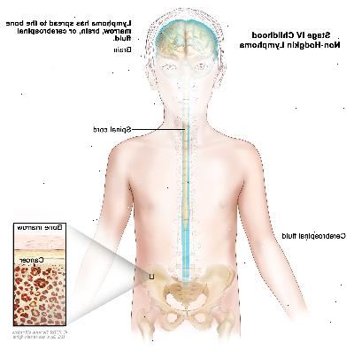 Στάδιο IV παιδική μη-Hodgkin λέμφωμα? Σχέδιο δείχνει τον εγκέφαλο, το νωτιαίο μυελό, και το εγκεφαλονωτιαίο υγρό μέσα και γύρω από τον εγκέφαλο και το νωτιαίο μυελό. Ένα ένθετο δείχνει τον καρκίνο στο μυελό των οστών.