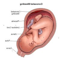 Εικονογράφηση επίδειξη κρυφή αιμορραγία κατά τη διάρκεια της εγκυμοσύνης