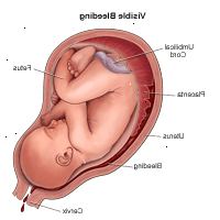 Απεικόνιση που καταδεικνύει ορατή αιμορραγία κατά τη διάρκεια της εγκυμοσύνης