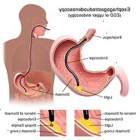 Εικονογράφηση ενός esophagogastroduodenoscopy διαδικασίας