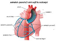 Εικονογράφηση των στεφανιαίων αρτηριών μετά από την ένεση της χρωστικής που χρησιμοποιείται σε καρδιακό καθετηριασμό ή PTCA