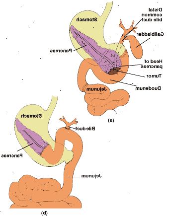 Pylorus συντηρητικά pancreaticoduodenectomy: ανατομία του αφαιρεθέντα περιοχή (α) και να επανασυνδεθεί πεπτικού σωλήνα με end-to-end pancreaticojejunostomy (β).