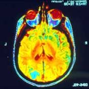 Μια μαγνητική τομογραφία του εγκεφάλου μπορεί να δείξει εάν ο καρκίνος έχει εξαπλωθεί (μετάσταση) εκεί.