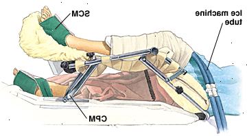 Άτομο που βρίσκεται στο κρεβάτι του νοσοκομείου με ένα γόνατο που υποστηρίζονται από συνεχή παθητική κίνηση μηχανής. Γόνατο είναι τυλιγμένο, και σωλήνες μηχανή πάγου πάει κάτω περιτύλιγμα. Οι Διαδοχικές μανσέτες συμπίεσης τυλιγμένο γύρω από τα δύο πόδια.