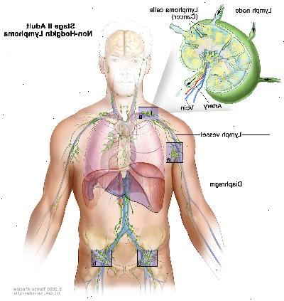 Σταδίου II ενήλικα μη-Hodgkin λέμφωμα? Σχέδιο δείχνει καρκίνο σε λεμφαδένες ομάδες κόμβο πάνω και κάτω από το διάφραγμα. Ένα ένθετο δείχνει ένα λεμφαδένα με ένα δοχείο λεμφαδένες, μία αρτηρία, και μια φλέβα. Τα κύτταρα λεμφώματος του καρκίνου που περιέχουν δείχνεται στο λεμφαδένα.