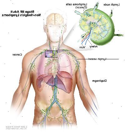 Στάδιο ΙΙΕ ενήλικα μη-Hodgkin λέμφωμα? Σχέδιο δείχνει καρκίνο σε μία ομάδα λεμφαδένας πάνω από το διάφραγμα και στον αριστερό πνεύμονα. Ένα ένθετο δείχνει ένα λεμφαδένα με ένα δοχείο λεμφαδένες, μία αρτηρία, και μια φλέβα. Τα κύτταρα λεμφώματος του καρκίνου που περιέχουν δείχνεται στο λεμφαδένα.