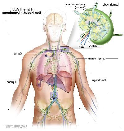 Στάδιο ΙΙΙ ενήλικες μη-Hodgkin λέμφωμα. Ο καρκίνος βρίσκεται σε μία ή περισσότερες ομάδες λεμφαδένων πάνω και κάτω από το διάφραγμα (α). Στο στάδιο IIIE, ο καρκίνος βρίσκεται σε λεμφαδένες ομάδες κόμβο πάνω και κάτω από το διάφραγμα και έξω από τους λεμφαδένες σε ένα κοντινό όργανο ή περιοχή (β). Στο στάδιο IIIS, ο καρκίνος βρίσκεται σε λεμφαδένες ομάδες κόμβο πάνω και κάτω από το διάφραγμα (α) και στον σπλήνα (γ). Στο στάδιο IIIS συν Ε, ο καρκίνος βρίσκεται σε λεμφαδένες ομάδες κόμβο πάνω και κάτω από το διάφραγμα, εκτός των λεμφαδένων σε ένα κοντινό όργανο ή περιοχή (β), και στην σπλήνα (γ).