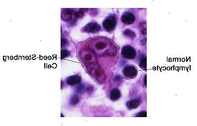 Κυττάρων Reed-Sternberg. Κύτταρα Reed-Sternberg είναι μεγάλα, μη φυσιολογικά λεμφοκύτταρα που μπορεί να περιέχει περισσότερα από ένα πυρήνα. Αυτά τα κύτταρα βρίσκονται σε Hodgkin λέμφωμα.