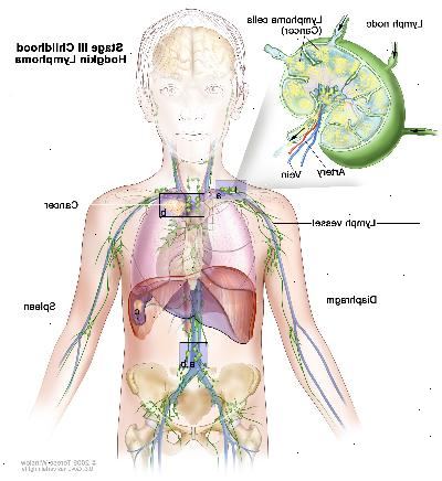 Στάδιο ΙΙΙ παιδική Hodgkin λέμφωμα. Ο καρκίνος βρίσκεται σε μία ή περισσότερες ομάδες λεμφαδένων πάνω και κάτω από το διάφραγμα (α). Στο στάδιο IIIE, ο καρκίνος βρίσκεται σε λεμφαδένες ομάδες κόμβο πάνω και κάτω από το διάφραγμα και έξω από τους λεμφαδένες σε ένα κοντινό όργανο ή περιοχή (β). Στο στάδιο IIIS, ο καρκίνος βρίσκεται σε λεμφαδένες ομάδες κόμβο πάνω και κάτω από το διάφραγμα (α) και στον σπλήνα (γ). Στο στάδιο IIIS συν Ε, ο καρκίνος βρίσκεται σε λεμφαδένες ομάδες κόμβο πάνω και κάτω από το διάφραγμα, εκτός των λεμφαδένων σε ένα κοντινό όργανο ή περιοχή (β), και στην σπλήνα (γ).