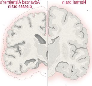 Αλλαγές στον εγκέφαλο στη νόσο του Alzheimer