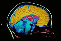 Μια εικόνα από ένα MRI του εγκεφάλου σάρωση φιλμ