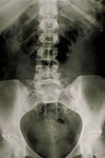 Φωτογραφία της οσφυϊκής x-ray