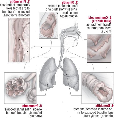 Πέντε λοιμώξεις του αναπνευστικού